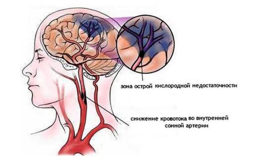 Дефицит кислорода при остеохондрозе