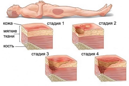 Стадии пролежней