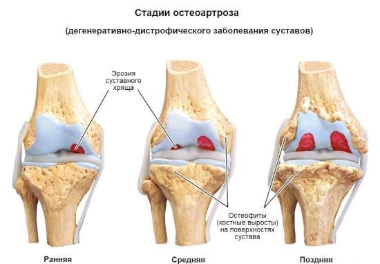 Стадии остеоартроза