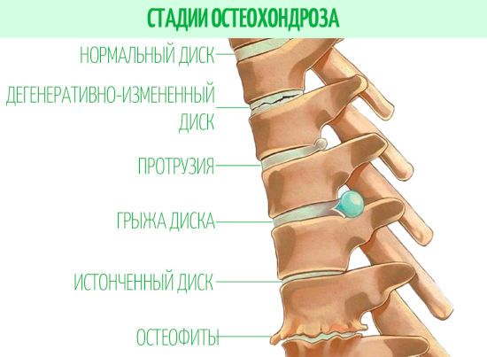 Стадии остеохондроза